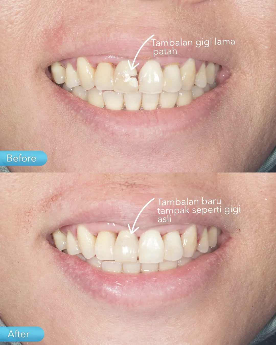 Dental filling result